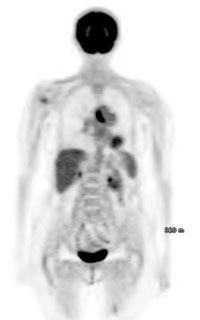 PET scan demonstrating second lesion