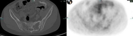 Axial CT (left image) and PET (right image) images of