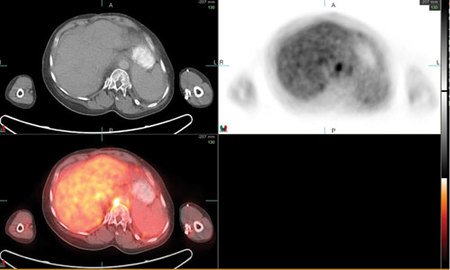 Axial CT (left image) and PET (right image) images