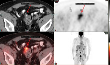 Hypermetabolic activity corresponding to the recurrent carcinoma in the left sigmoid colon