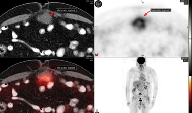 Hypermetabolic activity associated with metastatic omental implant