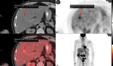 Hypermetabolic focus in the right lobe of the liver, suspicious for metastatic disease 