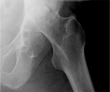 Figure 1: X-ray of the left hip shows advanced arthrosis of the