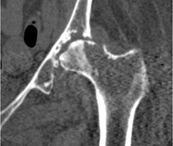 Figure 2: Coronal CT image of the left hip shows advanced