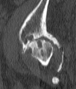 Figure 4: Sagittal CT image of the left hip shows advanced