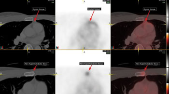  An axial image through the chest from the initial and follow up PET/CT examinations.