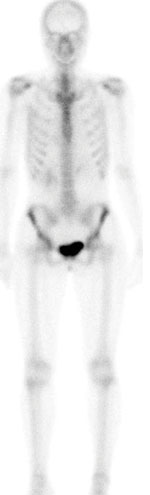 An anterior image of the bone scan does not reveal any suspicious focus of increased uptake in the sternum.