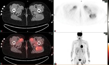 (a). Corresponding functional images demonstrate heterogeneous hypermetabolic