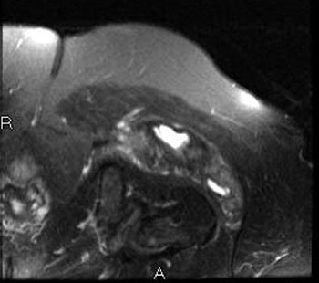 Axial MRIs of the left hip