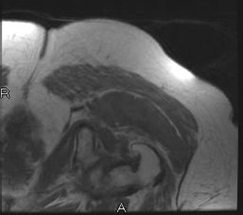 Axial MRIs of the left hip