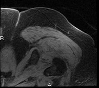 Axial MRIs of the left hip