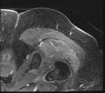 Axial MRIs of the left hip