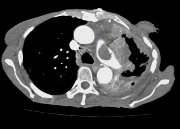 Figure 1: Axial CT angiogram images of the chest through the left pulmonary artery; tumor invasion of the left pulmonary artery.