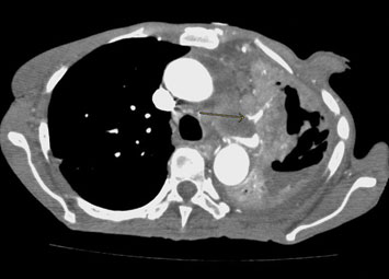 Figure 2: Axial CT angiogram images of the chest through the left pulmonary artery; Extension of the tumor from the left pulmonary artery to the bifurcation of the left upper lobar artery branch with narrowing of the artery.