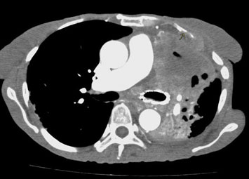 Figure 3: Axial CT angiogram images of the chest through the main pulmonary artery; Tumor infiltration of the left upper lung along mediastinal and lateral pleural surfaces and invasion of the anterior left chest wall (arrow).