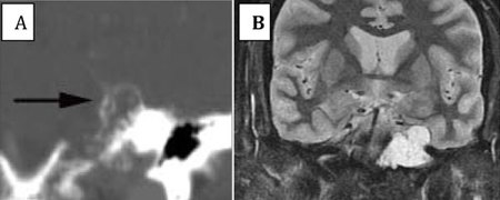 Axial postcontrast T1-weighted images with fat saturation.