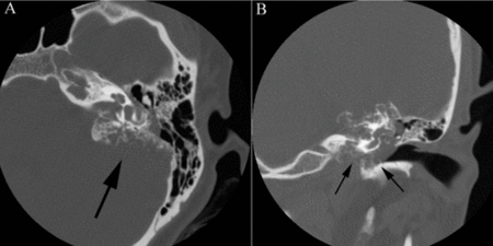 Axial (A) and coronal (B) images from a CT examination of the temporal bones.