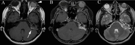 Axial images from an MRI examination of the brain. 