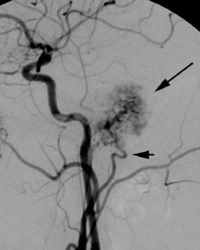 Lateral view from a catheter angiogram.