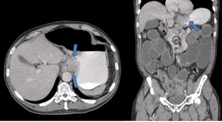 Axial CT (left) and coronal reformatted CT (right) images demonstrate lymphadenopathy, as well as focal thickening at the gastroesophageal junction (arrows) suspicious for the malignant primary lesion.