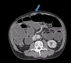 Nodule in the anterior omentum adjacent to the umbilicus (arrow). Multiple distended loops of small bowel are well demonstrated.