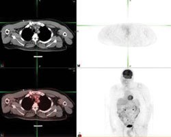 Clockwise from top left: Axial CT, axial PET, maximal intensity projection and fused axial PET-CT performed on Jan. 30 over the mediastinum demonstrate no abnormal hypermetabolism in the skeletal structures.