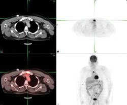 Clockwise from top left: Axial CT, axial PET, maximal intensity projection and fused axial PET-CT performed on June 27 over the mediastinum demonstrate a hypermetabolic lytic lesion in the sternal manubrium measuring approximately 2 cm x 1.1 cm, with a maximum standardized uptake value of 8.7.