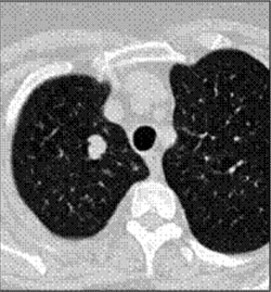 A chest CT axial image (lung windows)  from 2003 demonstrates a 1.5 cm lobulated nodule at the medial right upper lobe.