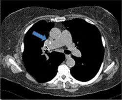 A recent chest CT axial image (soft tissue windows) demonstrates a right hilar mass (arrow), partially calcified and now compressing the right middle lobe bronchus.