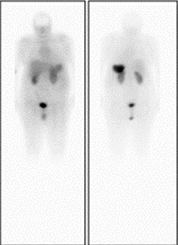 In-111 pentetreotide (octreoscan) anterior and posterior whole-body images show normal uptake in the liver, spleen, gastrointestinal tract and genitourinary tract.