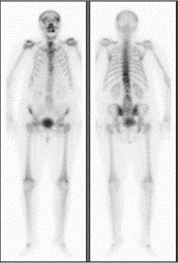 A Tc-99m MDP bone scan with anterior and posterior whole-body images show degenerative changes with no evidence of skeletal metastases.