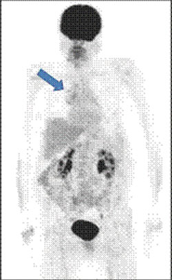 A PET FDG maximum-intensity projection image shows multiple foci of abnormal hypermetabolism in the right hilum and mediastinum with maximum standard uptake value up to 4.1, corresponding to soft tissue mass and adjacent lymph nodes.