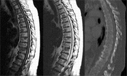 Sagittal T1 (left) and T2 (middle) weighted MRI images of the thoracic spine demonstrate diffuse multilevel metastatic disease. A CT reconstructed sagittal image (right, bone window) does not reveal corresponding abnormalities.