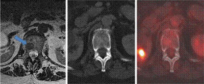 MRI (T2, left), CT (bone window, right) and fused PET/CT axial images at the L1 vertebral body demonstrate that the conspicuous signal abnormality on MRI (arrow) does not have a CT correlate. There is only mild, indistinct FDG avidity (standard uptake value <3).