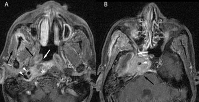 Figure 1: A) An axial post-contrast, fat-saturated T1 image, in keeping with origin from the posterosuperior aspect of the nasopharynx, shows the enhancing right nasopharyngeal mass is relatively sparing the right fossa of Rosenmüller (white arrow). There is posterolateral extension into the right longus capitis muscle (asterisk), indicating violation of the prevertebral fascia. Contiguous disease is resulting in encasement of the internal carotid artery and jugular vein just below the skull base (arrowheads). There is mild enhancement of the right temporalis and masseter muscles (black arrows), consistent with subacute denervation atrophy secondary to tumoral involvement of the mandibular nerve. B) Slightly craniad to image A, there is an enhancing mass centered in the right cavernous sinus, with anterior extension into the right foramen rotundum (white arrow). The cavernous carotid artery is encased and narrowed (arrowhead). There is posterior erosion through the clivus into the prepontine cistern (black arrow).