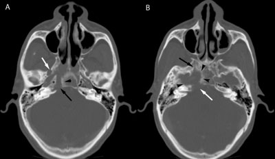 Figure 2: A) An axial CT image shows abnormal widening and erosion of the foramen lacerum (black arrow), with abnormal sclerotic change in the adjacent petrous apex (asterisk) and basisphenoid (arrowhead). There also is abnormal widening of the right foramen ovale (white arrow). B) Slightly craniad to image A, there is more extensive peripheral bone destruction centered above the foramen lacerum involving the carotid canal (arrowheads). There is involvement of the posterior aspect of the vidian canal (black arrow), and there is erosion into the posterior cranial fossa (white arrow).