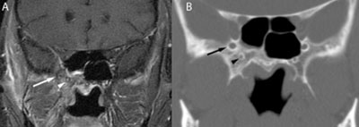 Figure 3: A) A coronal post-contrast, fat-saturated T1 image shows asymmetric enlargement and enhancement of the right foramen rotundum (white arrow) and right vidian canal (white arrowhead), consistent with the presence of a tumor. B) A coronal CT image shows the anterior aspect of the vidian canal (arrowhead) appears normal at the level of the orbital apex. The right foramen rotundum (black arrow) is subtly enlarged compared with the normal left side, but it has an intact normal sclerotic border.