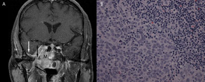 Figure 4: A) A large enhancing mass (M) has extended superiorly from the roof of the nasopharynx into the right cavernous sinus, traversing the right central skull base. There is a tumor widening the foramen ovale and extending along the mandibular nerve into the right masticator space (black arrows). There is extension along the dura of the floor of the right middle cranial fossa (white arrow). B) The nasopharyngeal biopsy shows a cohesive sheet of malignant cells showing prominent nucleoli, nuclear pleomorphism and high nuclear to cytoplasmic (N/C) ratio, in a background of lymphocytic infiltrate (haematoxylin and eosin, 400 times). 