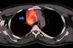 Figure 1. An axial fused PET/CT image demonstrates a hypermetabolic, right paratracheal nodal mass (arrow).