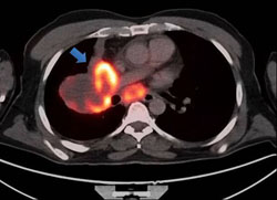 Figure 2. An axial image from the same scan demonstrates a large hypermetabolic right mediastinal/hilar mass (arrow).