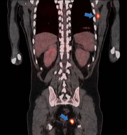 Figure 3. Coronal reformat from the PET/CT reveals hypermetabolic foci in the left serratus anterior muscle and left ischiorectal fossa (arrows).