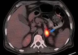 Figure 4. An axial fused PET/CT image reveals a presumptively metastatic, hypermetabolic left adrenal nodule (arrow).