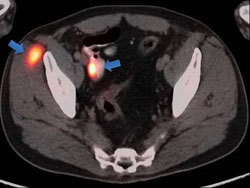 Figure 5. An axial fused PET/CT image reveals a hypermetabolic nodule in the right gluteal musculature (arrow), as well as hypermetabolic wall thickening of a segment of the small bowel (arrow), both presumptively metastatic.