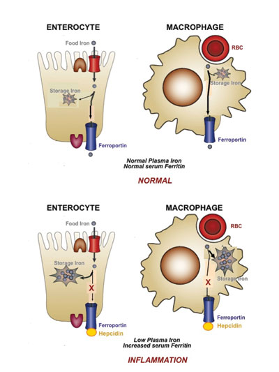 Anemia due to chronic inflammation has a distinct and compelling pathophysiology. In these patients, iron homeostasis is deranged.