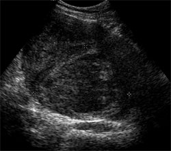 Figure 1. Left image: A sagittal ultrasound of the uterus in 2006 demonstrates a large posterior uterine leiomyoma (arrow). Right image: By 2012, the uterine leiomyoma has markedly enlarged and displaces the myometrium.