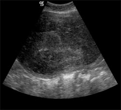 Figure 1. Left image: A sagittal ultrasound of the uterus in 2006 demonstrates a large posterior uterine leiomyoma (arrow). Right image: By 2012, the uterine leiomyoma has markedly enlarged and displaces the myometrium.