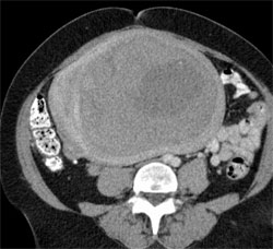 Figure 2. Left image: Axial CT of the pelvis with contrast demonstrates a 23 cm x 16 cm x 20 cm enhancing fibroid (arrow) with necrosis surrounded by a thin layer of myometrium and displacement the uterine cavity to the right. Right image: Axial post gadolinium T1 weighted MRI demonstrates enhancing fibroid with an area of unenhanced necrosis (arrow).   