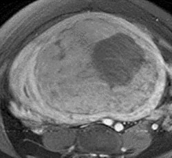 Figure 2. Left image: Axial CT of the pelvis with contrast demonstrates a 23 cm x 16 cm x 20 cm enhancing fibroid (arrow) with necrosis surrounded by a thin layer of myometrium and displacement the uterine cavity to the right. Right image: Axial post gadolinium T1 weighted MRI demonstrates enhancing fibroid with an area of unenhanced necrosis (arrow).   