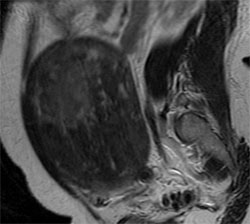 Figure 3. Sagittal T2 weighted MRI demonstrates a hypointense leiomyoma (arrow) with heterogeneous signal in the area of necrosis.