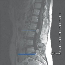 Sagittal contrast-enhanced T1 image of the lumbosacral spine shows lesions at L2-3 (thin arrow) and L5-S1 (thick arrow).